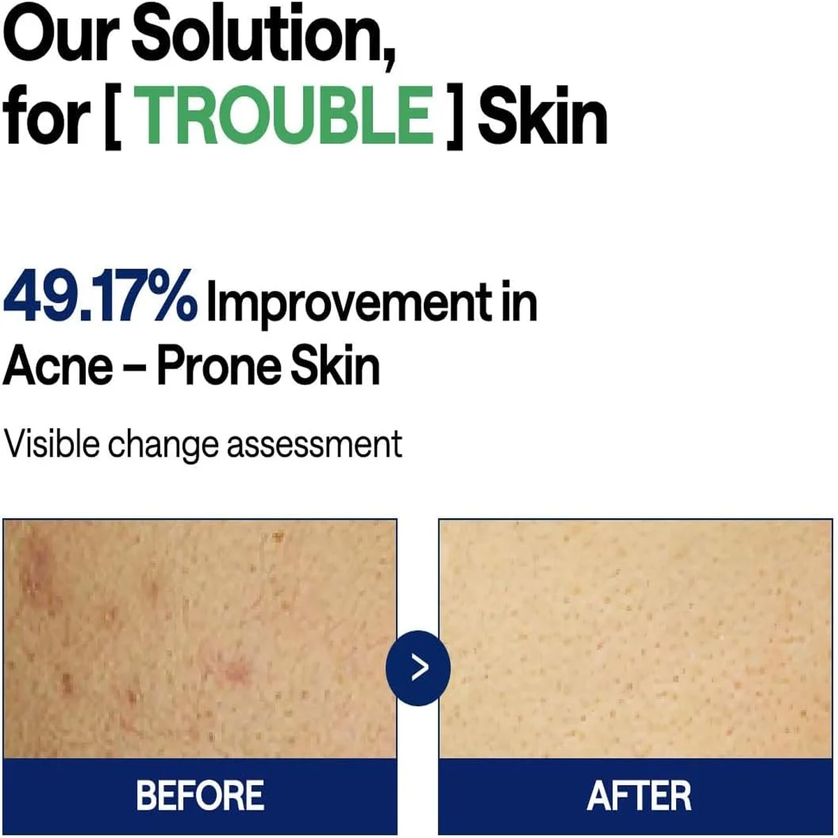 MEDIHEAL Teatree Trouble Pad 100 Pads